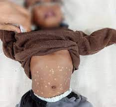 शहडोल में इलाज के नाम पर 3 महीने की बच्ची को गर्म सलाखों से दागा, बच्ची की हुई मौत