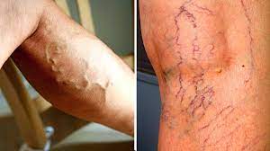 क्या गर्मियों में पैर की नसें नीली और मोटी दिख रही हैं? यह गंभीर बीमारी हो सकती है वजह