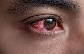 आई फ्लू क्या है? जानिए मानसून में इससे बचाव के 5 तरीके