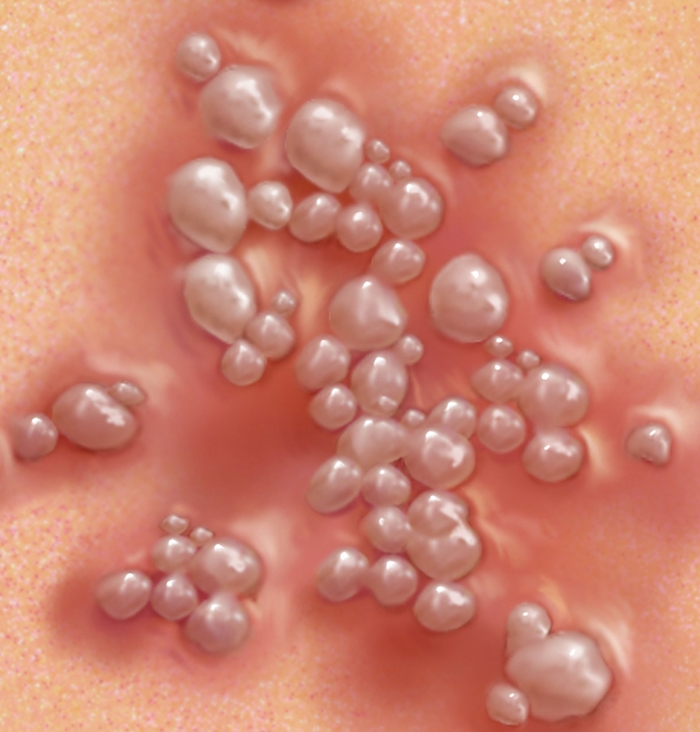 क्या है जेनिटल हर्पीस इन्फेक्शन, इसके कारण, लक्षण व उपचार