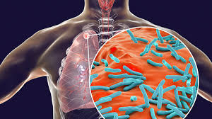 टीबी के इन लक्षणों से वक्त रहते करें इसकी पहचान, जानें क्या है ताजा स्टडी का दावा