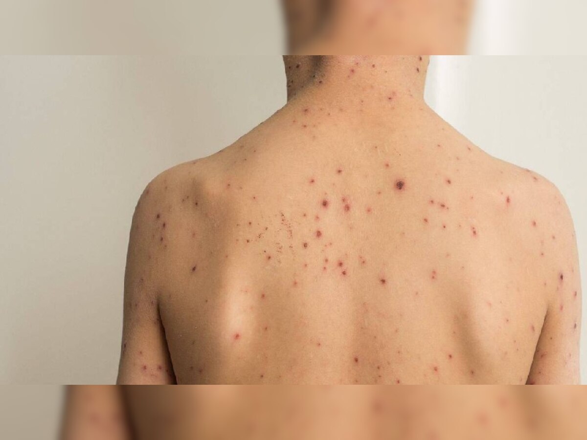 मंकीपॉक्स को लेकर सरकार अलर्ट, केंद्र ने सभी राज्यों को जारी की एडवाइजरी